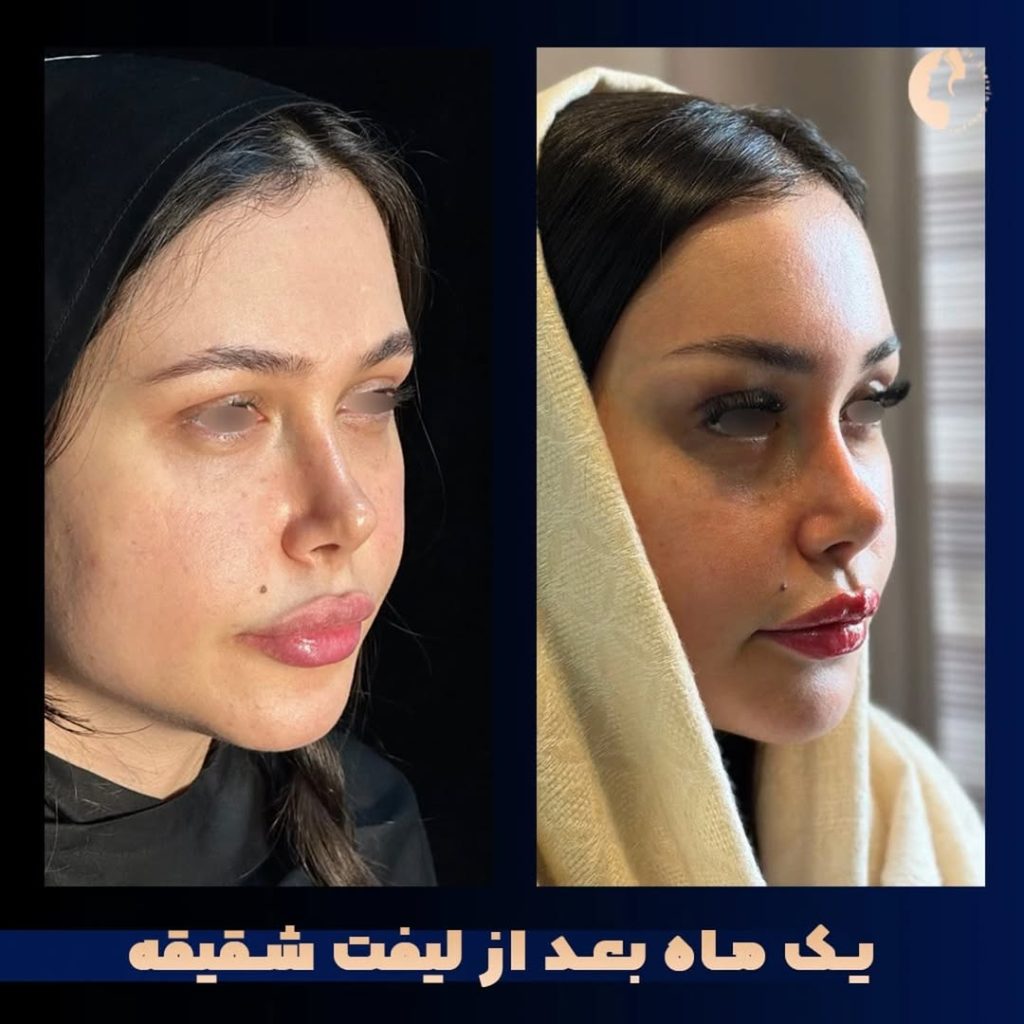 قبل از لیفت شقیقه این نکات مهم را بدانید.