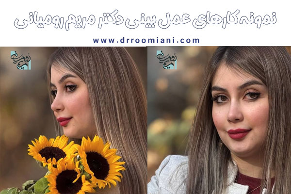 نمونه کارهای عمل بینی دکتر مریم رومیانی