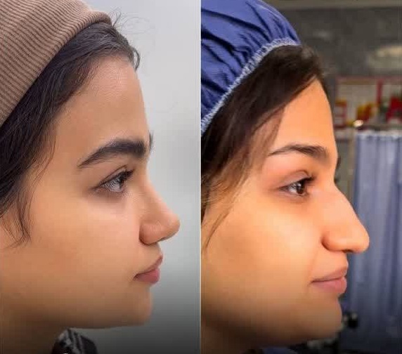 جراحی بینی در کرج